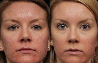 Atunṣe Laser ti oju ṣaaju ati lẹhin