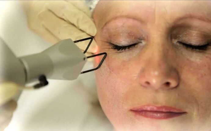 yiyọ lesa ti wrinkles ni ayika awọn oju